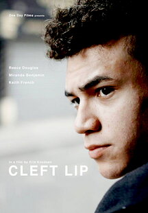 Cleft Lip